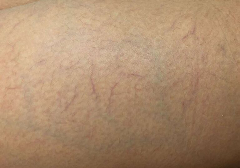 علل ایجاد تلانژکتازی