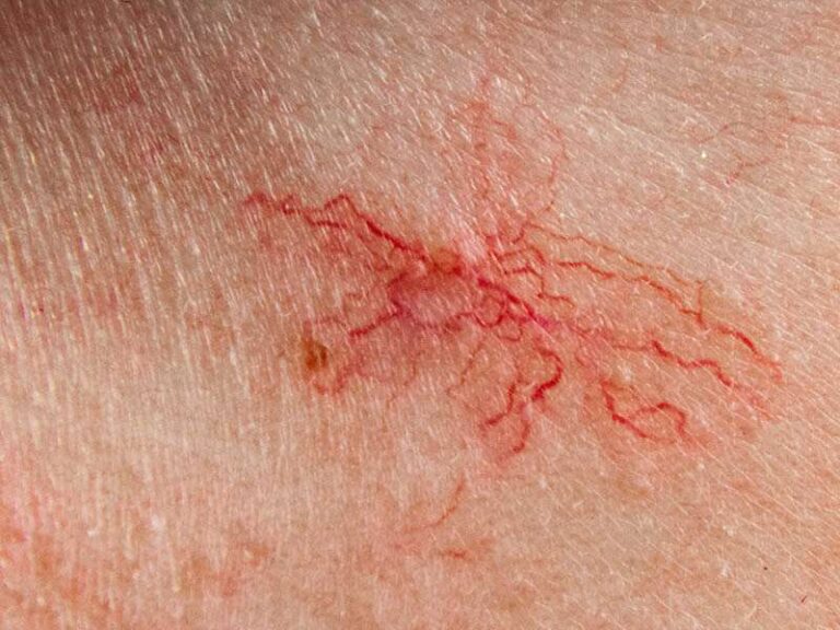 علائم تلانژکتازی